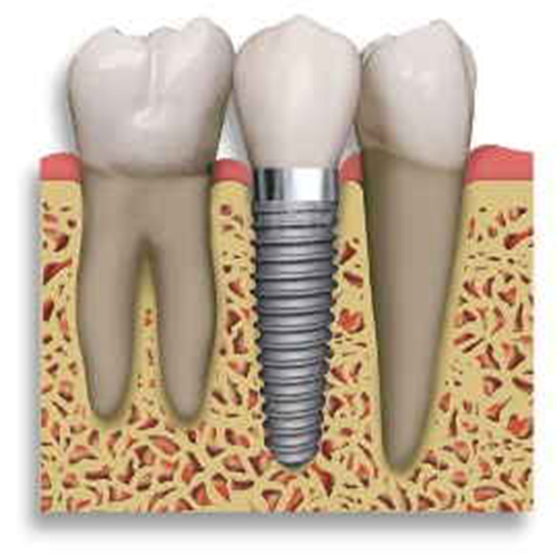 Dental Implants (including crowns)